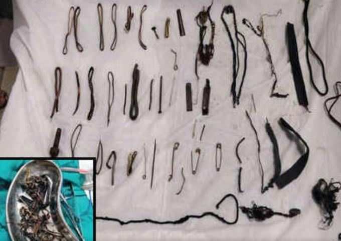 1.5kg of nails, rings found in Maharashtra woman’s tummy