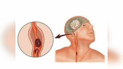 आरोग्यमंत्र - अर्धांगवायूचे उपचार व कसा टाळाल?