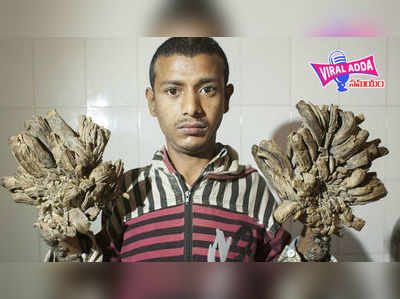 Bangladesh Tree Man: చెట్టులా మారిపోతున్న యువకుడు.. పరిస్థితి దయనీయం!
