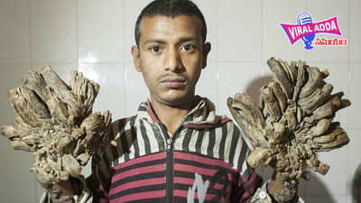 Bangladesh Tree Man: చెట్టులా మారిపోతున్న యువకుడు.. పరిస్థితి దయనీయం! 