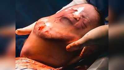 Baby Born Inside Amniotic Sac: குழந்தை பிறப்பில் ஒரு ஆச்சரியம் - நீர்க் குடம் உடையாமல் வெளியே வந்த அதிசயம்!