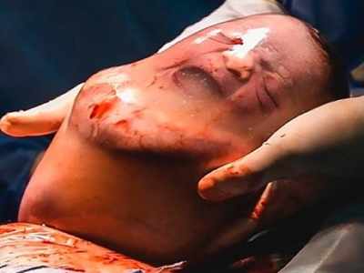 Baby Born Inside Amniotic Sac: குழந்தை பிறப்பில் ஒரு ஆச்சரியம் - நீர்க் குடம் உடையாமல் வெளியே வந்த அதிசயம்!