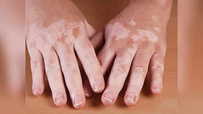 World Vitiligo Day: सफेद दाग हों तो रबर-कैमिकल से बनाएं दूरी
