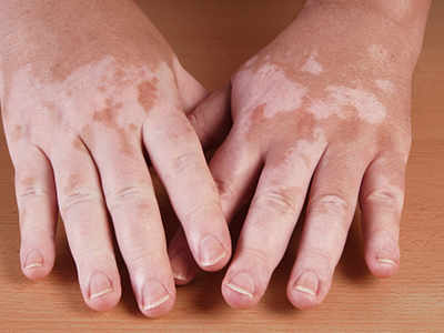 World Vitiligo Day: सफेद दाग हों तो रबर-कैमिकल से बनाएं दूरी