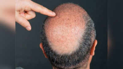 पुरुषांमधील केसगळती आणि टक्कल