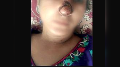 गुजरात: पैसे लेकर विवाद में पति ने पत्‍नी की नाक चबाई, 15 टांके लगे