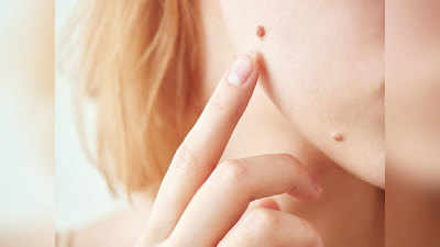 Skin Tags यानी त्वचा के मस्सों को हटाने के घरेलू उपाय