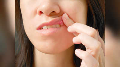 इन घरेलू तरीकों से ठीक हो जाएगा Mouth Ulcer, जानें कारण भी