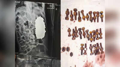 अहमदाबाद: सिविल हॉस्पिटल में डॉक्टरों ने एक शख्स के पेट से निकालीं लोहे की 452 चीजें