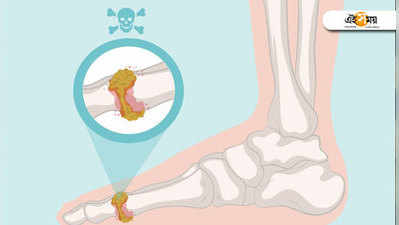 কমছে আয়ু, ইউরিক অ্যাসিডে পাত্তা না-দেওয়ায় বাড়ছে চিন্তা