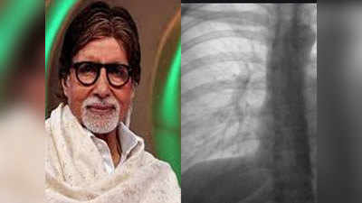 Amitabh Bachchan 8 साल तक नहीं पहचान पाए टीबी के लक्षण, आप ऐसे रहें अलर्ट