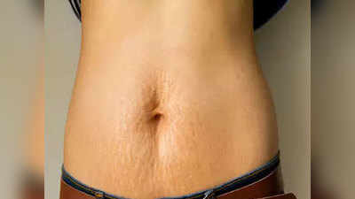 Weight Loss के बाद Stretch marks से बचना है तो फॉलो करें ये टिप्स