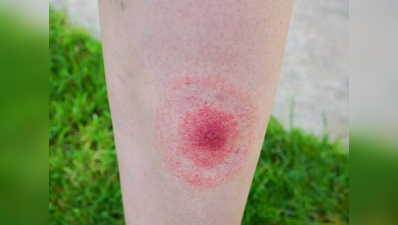 स्टडी: बस 15 मिनट में डायग्नोज होगी Lyme Disease