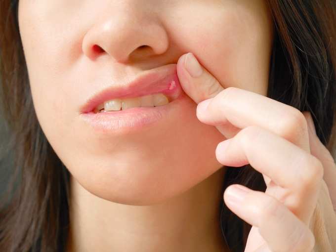 mouth ulcer