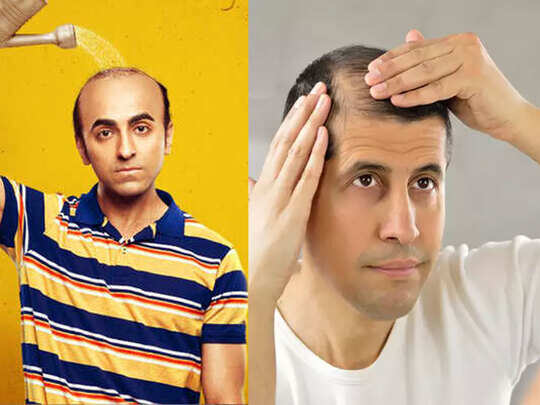 Men's Hairstyle For Balding Hair - बाला जैसे लड़के गंजापन छिपाने के लिए ये 4 हेयर स्टाइल Men's Hairstyle For Balding Hair - बाला जैसे लड़के गंजापन छिपाने के लिए ये 4 हेयर स्टाइल
