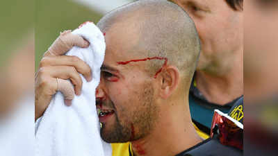 भावाने मारलेला चेंडू थेट नाकावर, ऑस्ट्रेलियाचा खेळाडू रक्तबंबाळ