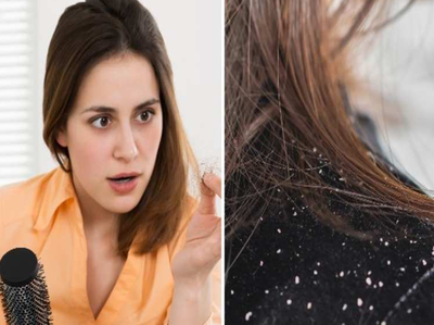 सर्दियों में Dandruff आएगा ही नहीं, ये 4 टिप्स फॉलो करें