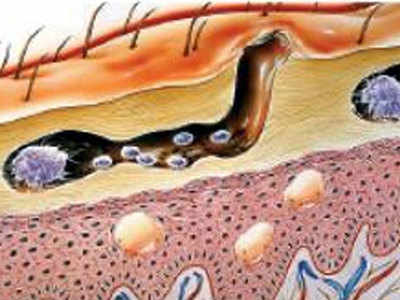 शरीर पर चकत्ते, दाने, खुजली...स्कैबीज तो नहीं
