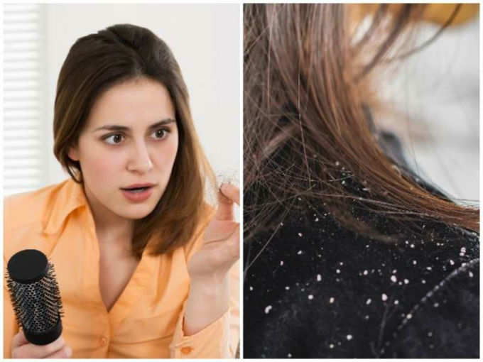 Dandruff on Hair