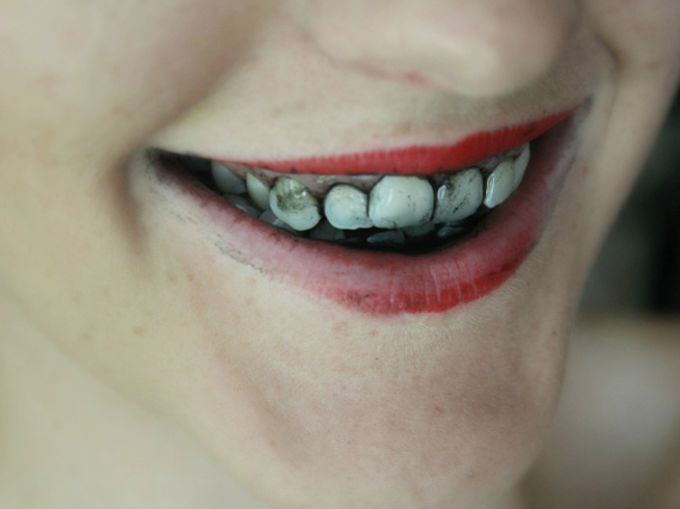 white-teeth-3