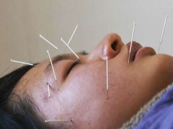 acupuncture-1