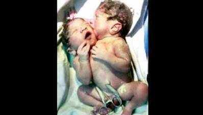 મુંબઈમાં જન્મ્યું બે માથા અને એક હ્રદય વાળું બાળક