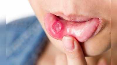Home Remedies For Mouth Ulcer : મોઢું આવ્યું હોય તો અપનાવો આ અસરકારક ઘરેલું ઉપાયો