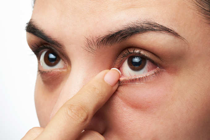 ​ಒಣಗಣ್ಣಿನ ಲಕ್ಷಣ (Dry eye syndrome)