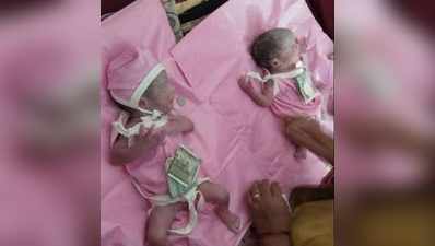 સુરતઃ માતાની જેમ 24 આંગળીઓ સાથે જન્મ્યા જોડ્યાં બાળકો