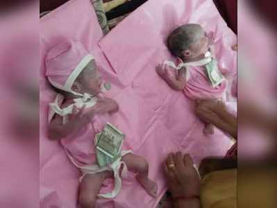 સુરતઃ માતાની જેમ 24 આંગળીઓ સાથે જન્મ્યા જોડ્યાં બાળકો