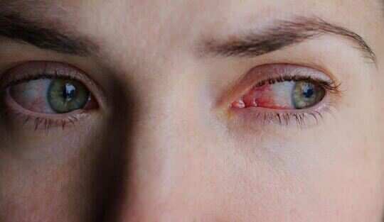 effective home remedies to cure conjunctivitis