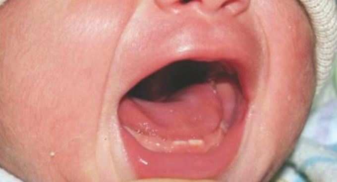 બાળક દાંત સાથે જન્મવાનું કારણ શું હોઈ શકે?
