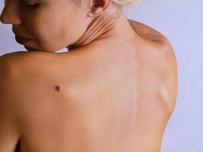 ​ത്വക്കിലെ അര്‍ബുദം (Skin Cancer)