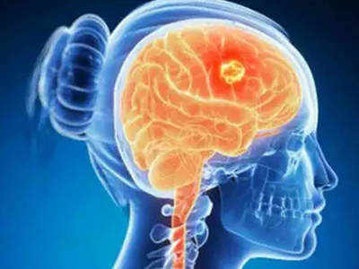 World Brain Tumor Day: વર્તણૂકમાં થતાં સામાન્ય ફેરફારોને અવગણવાની ભૂલ ના કરશો 