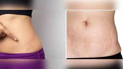 Stretch Marks: எல்லோரையும் துரத்தும் ஸ்ட்ரெச் மார்க், காரணங்களும் தீர்வுகளும்..