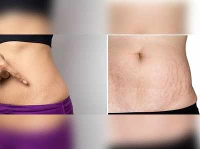 Stretch Marks: எல்லோரையும் துரத்தும் ஸ்ட்ரெச் மார்க், காரணங்களும் தீர்வுகளும்..