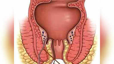 आरोग्यमंत्र: भगंदर किंवा फिश्चुला कसा होतो? उपचार काय?