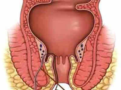 आरोग्यमंत्र: भगंदर किंवा फिश्चुला कसा होतो? उपचार काय?