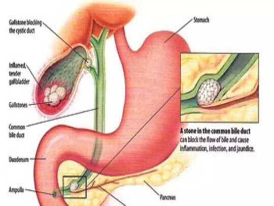 Gallstones : பித்தப்பையில் கல் இருக்கா... நீங்களே கண்டுபிடிக்க எளிய வழி.. -  causes and symptoms for gallbladder stones - Samayam Tamil