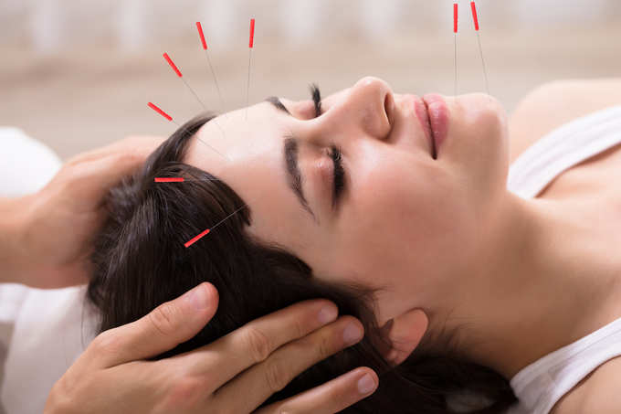 Acupuncture Treatment