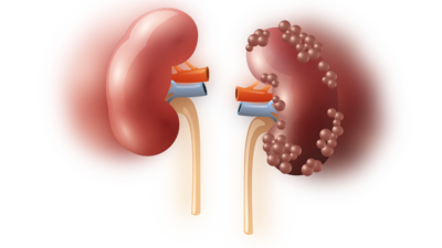 world kidney day 2020: இந்த 5 அறிகுறி இருந்தா உங்க கிட்னி பாதி காலினு அர்த்தம்...