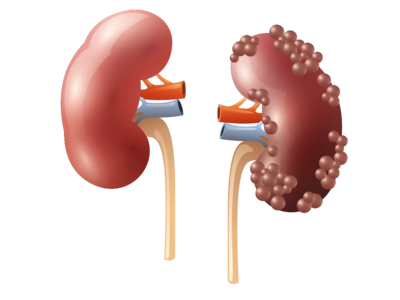 world kidney day 2020: இந்த 5 அறிகுறி இருந்தா உங்க கிட்னி பாதி காலினு அர்த்தம்...