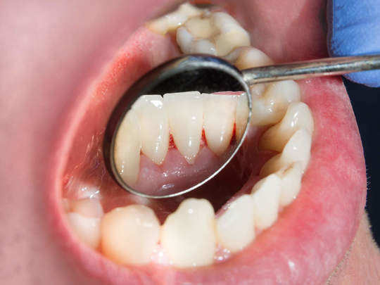 Dant ka hilna kaise roke gharelu upay - घरेलू उपचार से दांतों का हिलना कैसे  बंद करें?