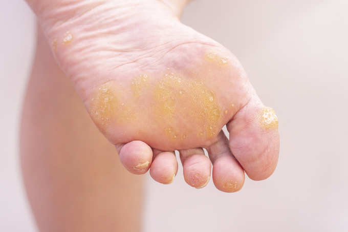 Warts and corns on a womans foot