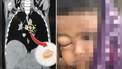 3 વર્ષના બાળકનો ચહેરો ફુગ્ગાની જેમ ફૂલી ગયો, ડૉક્ટરે CT સ્કેન કરતાં મળ્યું ચોંકાવનારું કારણ