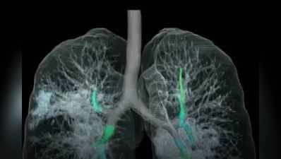 કોરોના વાયરસથી સંક્રમિત દર્દીના ફેફસાની પહેલા 3D તસવીર સામે આવી