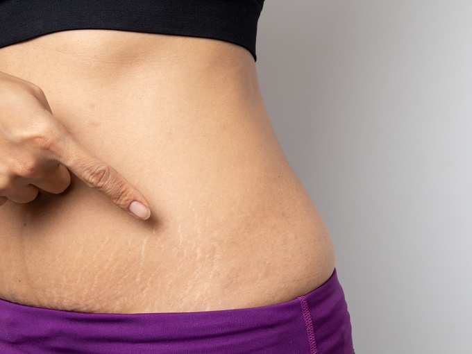 pregnancy stretch marks