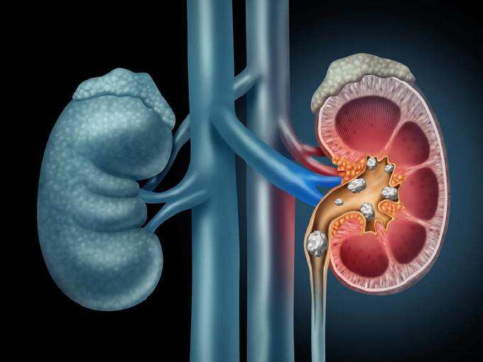 Kidney Stone : किडनी स्टोन के दर्द को दूर करने के लिए पानी में मिलाकर पिएं यह एक चीज, कुछ ही दिनों में दिख जाएगा फायदा