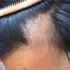 Scalp folliculitis Symptoms pictures causes shampoos and creams