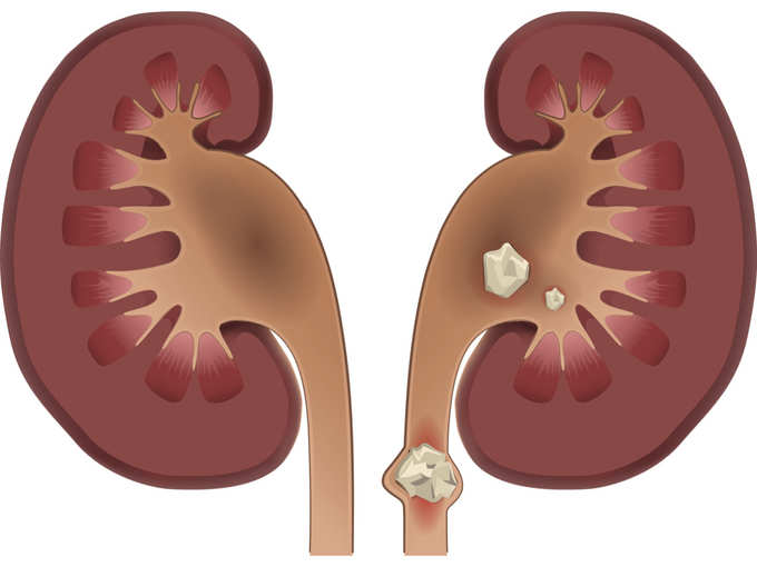 kidney stones istock